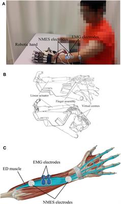 The Effects of Upper-Limb Training Assisted with an Electromyography-Driven Neuromuscular Electrical Stimulation Robotic Hand on Chronic Stroke